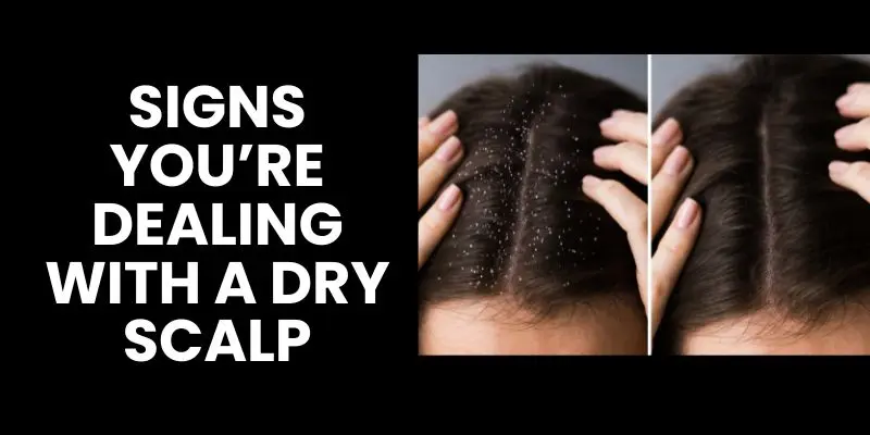 Visual chart comparing dry scalp symptoms with dandruff, showing flake size, oiliness, and irritation