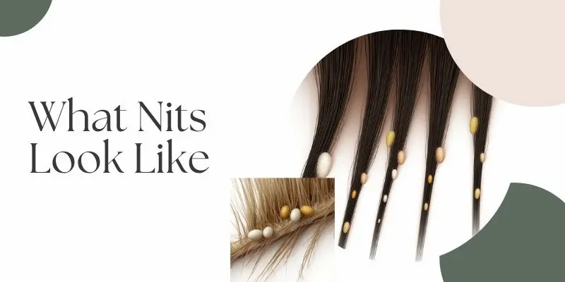 Hanover And Tyke 1 1 Close-Up Of Head Lice Eggs Attached To Hair