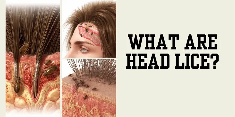 What Are Head Lice 1 Head Lice Living Close To The Scalp