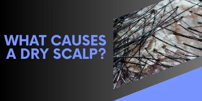 Diagram of dry scalp triggers like hard water, cold weather, sulfates, and poor diet