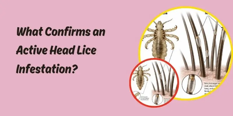 Live Head Louse And Nits Attached Close To The Scalp