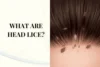 What Are Head Lice? Signs, Nits, Causes & Safe Treatment - Post Thumbnail