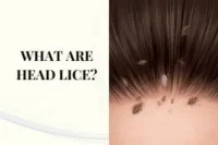 What Are Head Lice? Signs, Nits, Causes & Safe Treatment