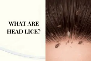 What Are Head Lice? Signs, Nits, Causes & Safe Treatment
