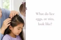 What Do Lice Eggs (Nits) Look Like? 7 Signs to Check